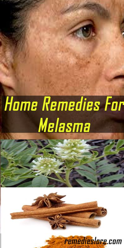 home remedies for melasma