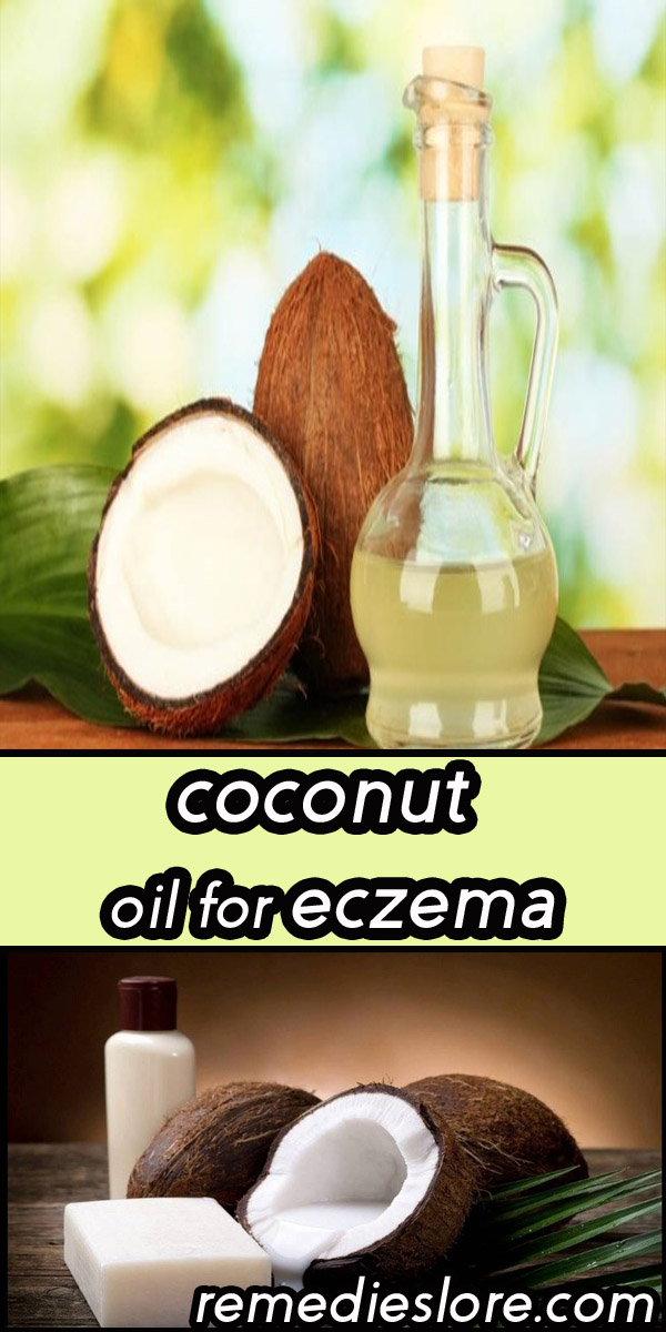 Coconut Oil for Eczema - Remedies Lore