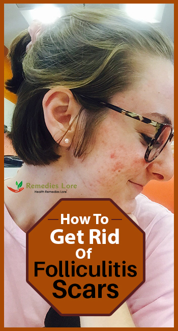 How to get rid of folliculitis scars