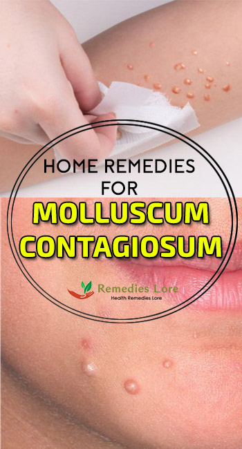 Home Remedies for Molluscum Contagiosum