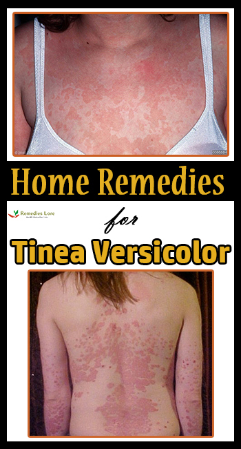 Home Remedies for Tinea Versicolor