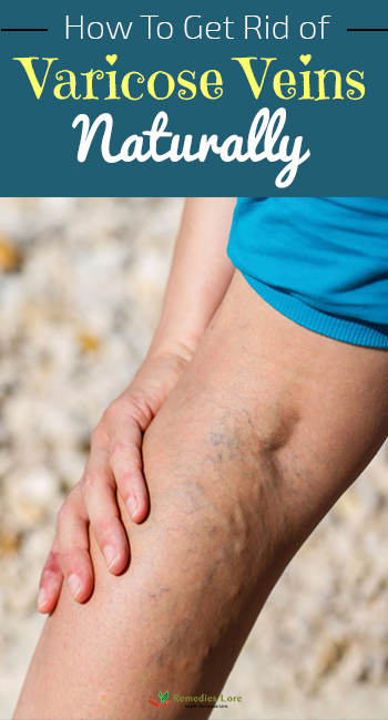 How To Get Rid of Varicose Veins Naturally