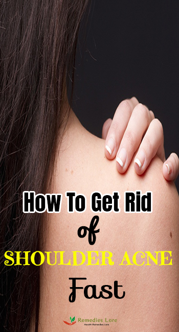 How To Get Rid of Shoulder Acne Fast