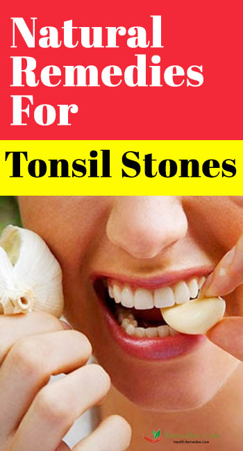 Natural Remedies For Tonsil Stones