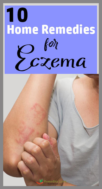 10 Home remedies For Eczema