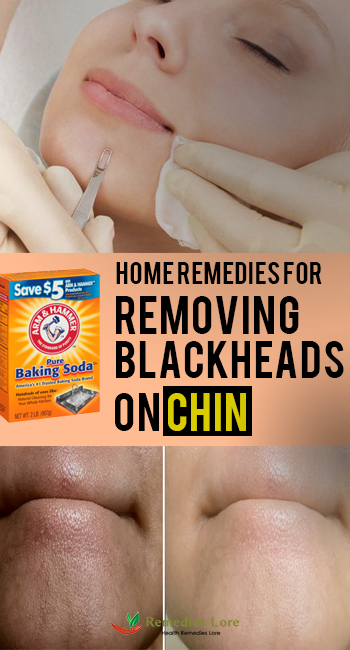 Home Remedies For Removing Black Heads On Chin