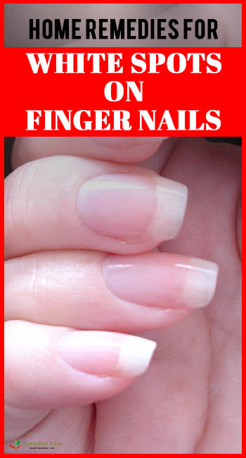 Home Remedies For White Spots On Finger Nails