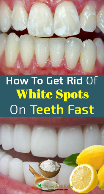 How To Get Rid Of White Spots On Teeth Fast Remedies Lore