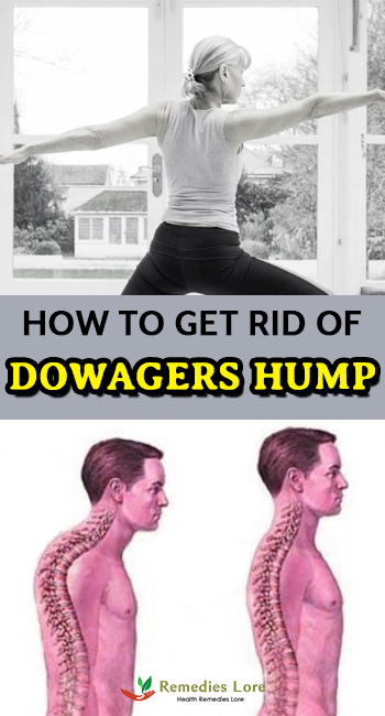 How to Get Rid of Dowagers Hump