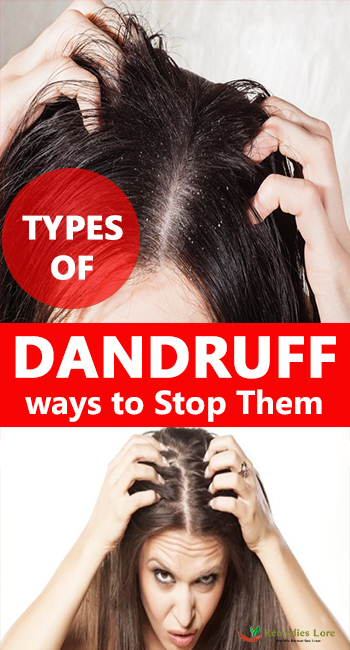 Types Of Dandruff And Ways To Stop Them