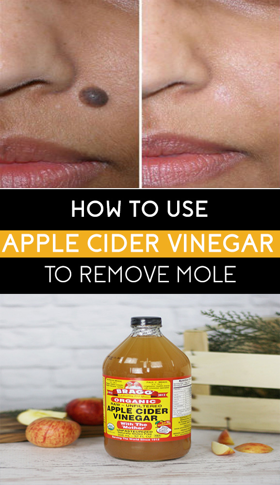 How To Remove a Mole Using Apple Cider Vinegar Remedies Lore