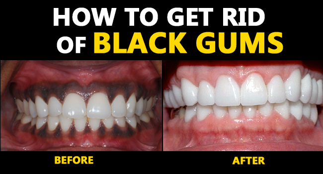 How to Get Rid of Black Gums - Remedies Lore