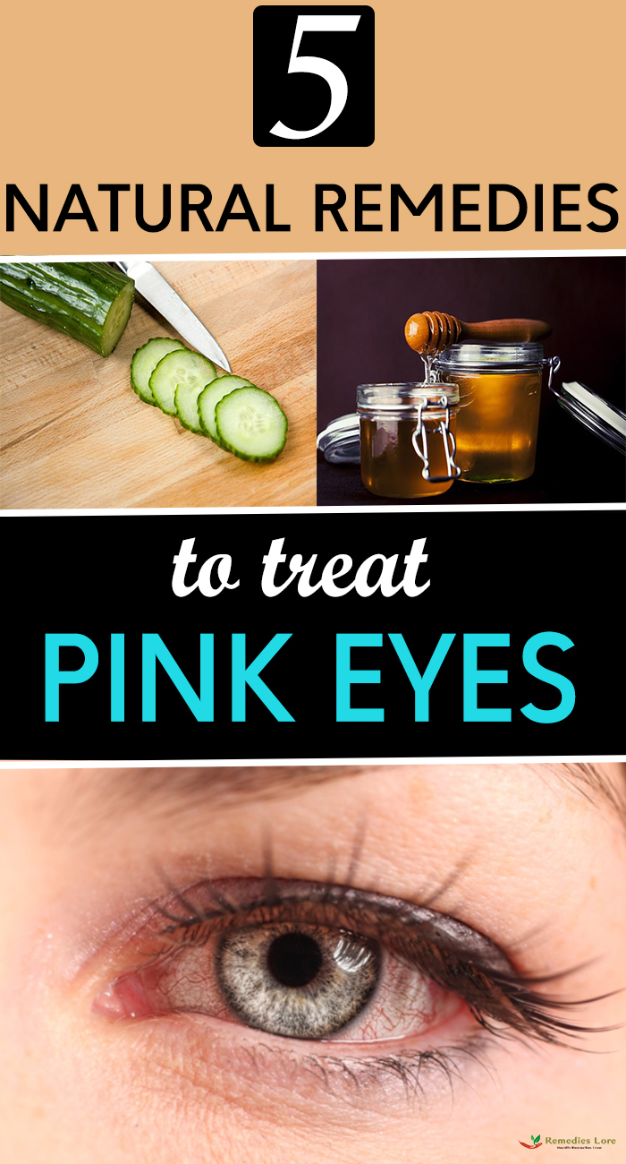 5 Natural Remedies To Treat Pink Eyes