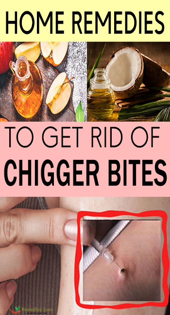 Home Remedies To Get Rid Of Chigger Bites