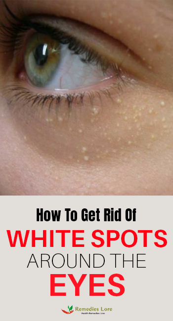 How To Get Rid Of White Spots Around The Eyes