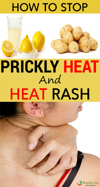 How To Stop Prickly Heat And Heat Rash