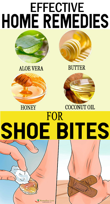 Effective Home Remedies For Shoe Bites