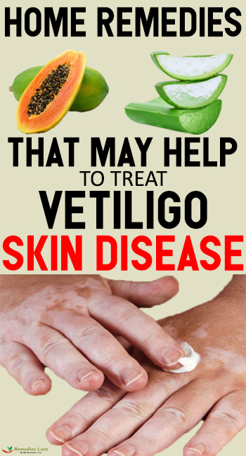 Home Remedies That May Help To Treat Vetiligo Skin Disease