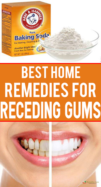 Best Home Remedies For Receding Gums