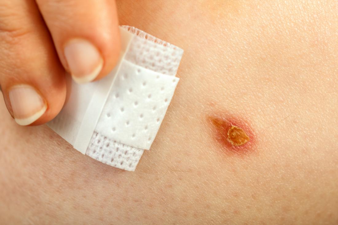 burn-wound-slowly-healing-because-of-diabetes-under-plaster