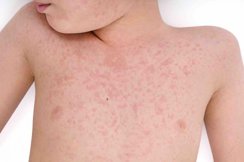 child-allergic-reaction-houston-health-clinic-846x562
