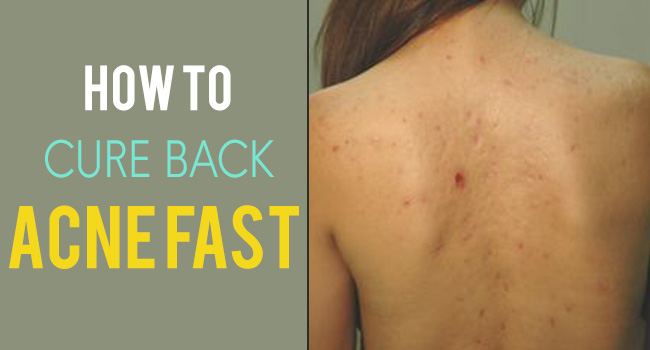 how to cure back acne fast fb
