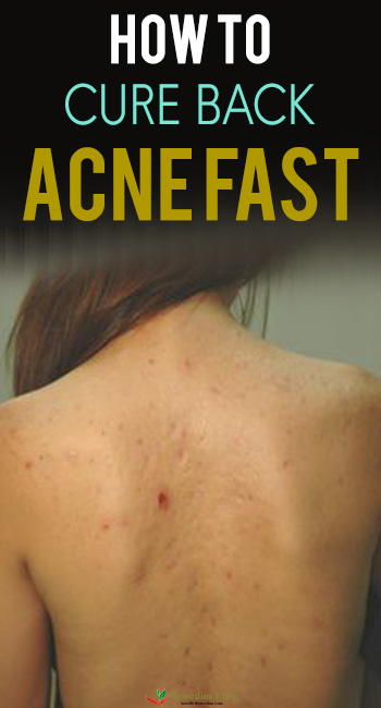 how to cure back acne fast