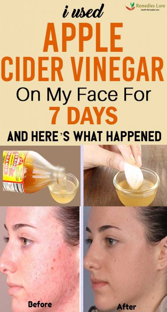 I Used Apple Cider Vinegar On My FaceFor 7 Days And Here’s What Happened