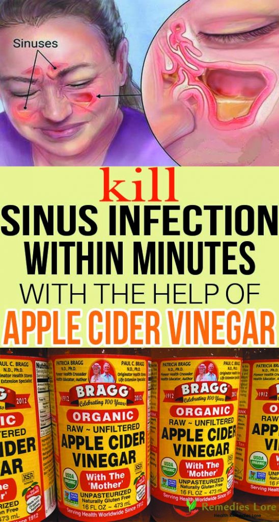 Kill Sinus Infection Within Minutes With The Help Of Apple Cider Vinegar