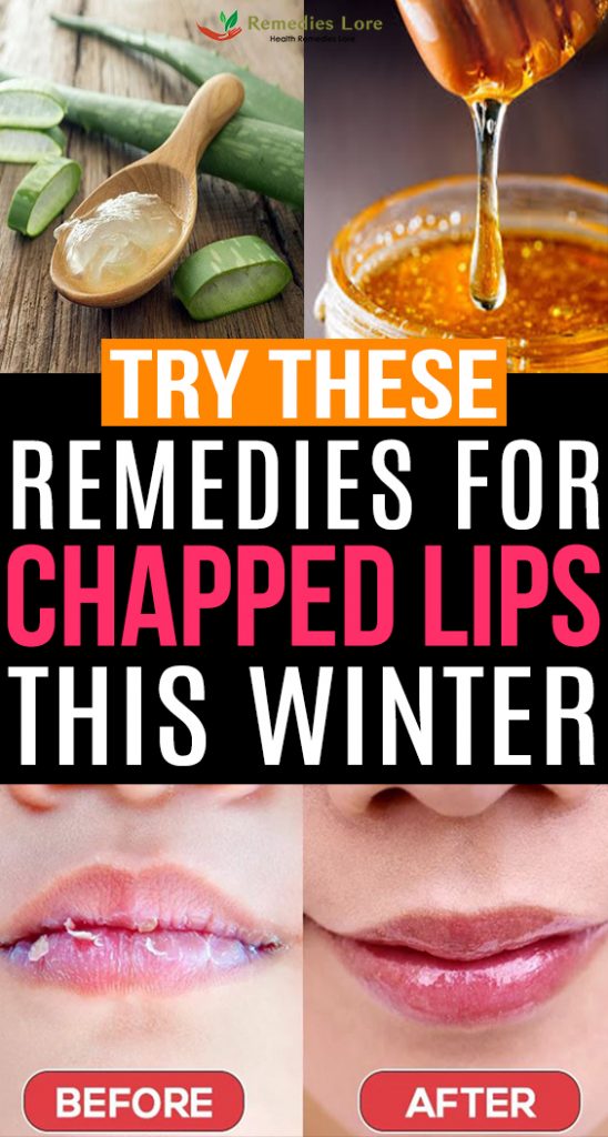 Try These Remedies For Chapped Lips This Winter - Remedies  