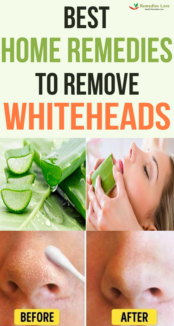Best home remedies to remove whiteheads