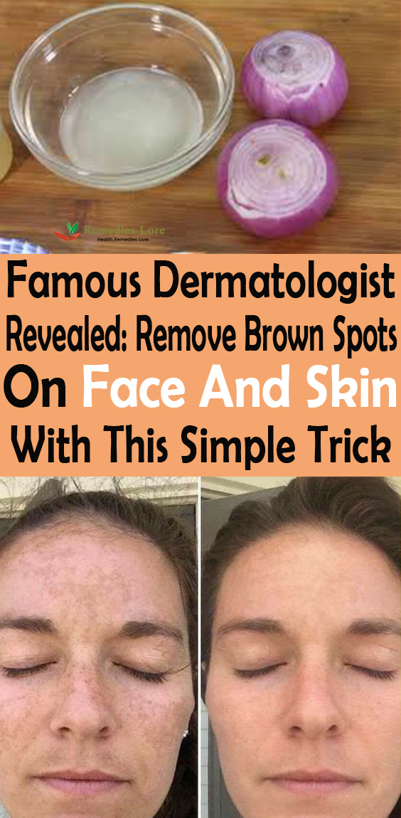 Famous Dermatologist Revealed: Remove Brown Spots On Face And Skin With This Simple Trick