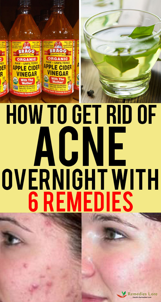 Home Remedies For Acne - Remedies Lore