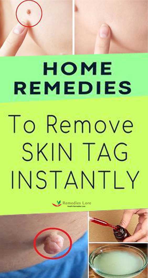 Top 10 Home Remedies to Remove Skin Tags Naturally-min