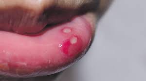 How To Get Rid Of Cold Sores – 10 Effective Ways To Try