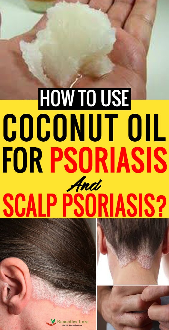 How to Use Coconut Oil for Psoriasis and Scalp Psoriasis--min