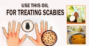 Use These Oils For Treating Scabies