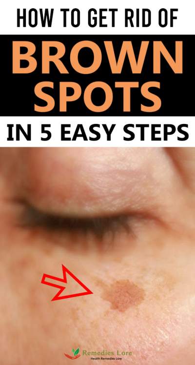How to Get Rid Of Brown Spots in 5 Easy Steps