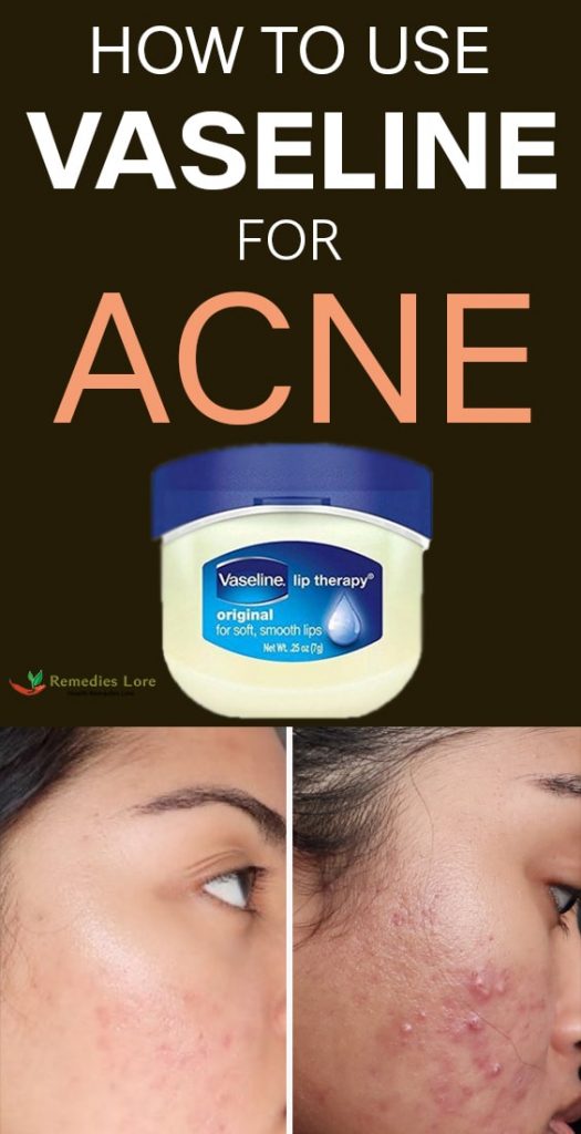 How to Use Vaseline for Acne