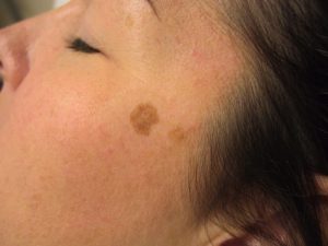 How to Get Rid Of Brown Spots in 5 Easy Steps