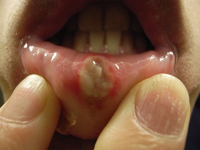How Long Do Canker Sores Last? – Different Healing Stages and Home Remedies