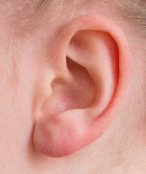 Pimple In Ear – Potential Causes, Treatment, Prevention and Much More