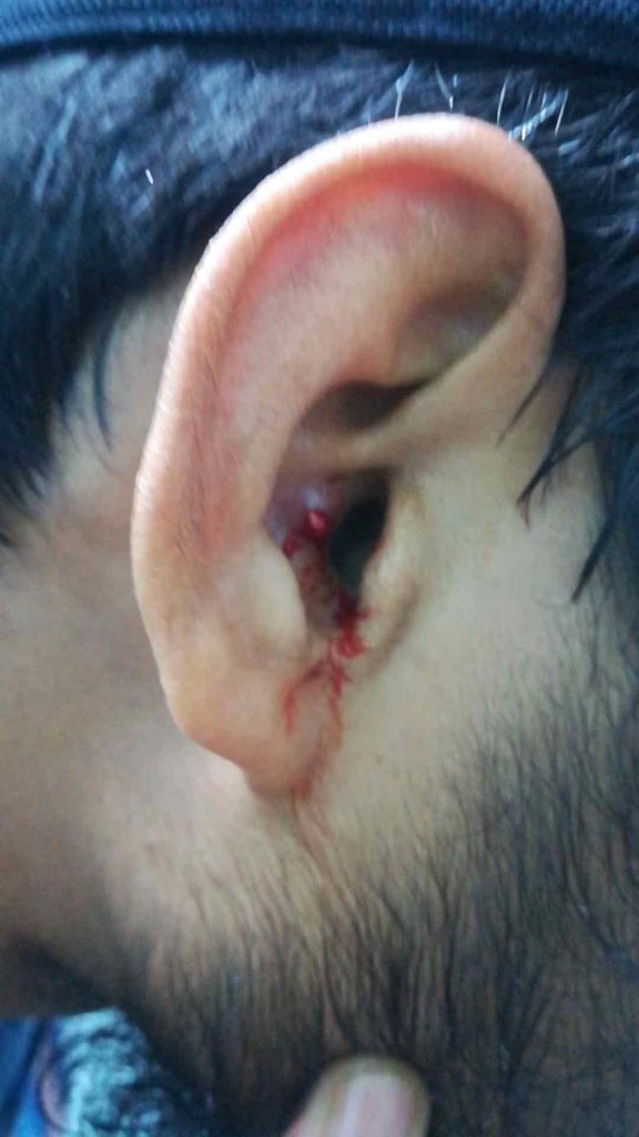 pimple in the ear