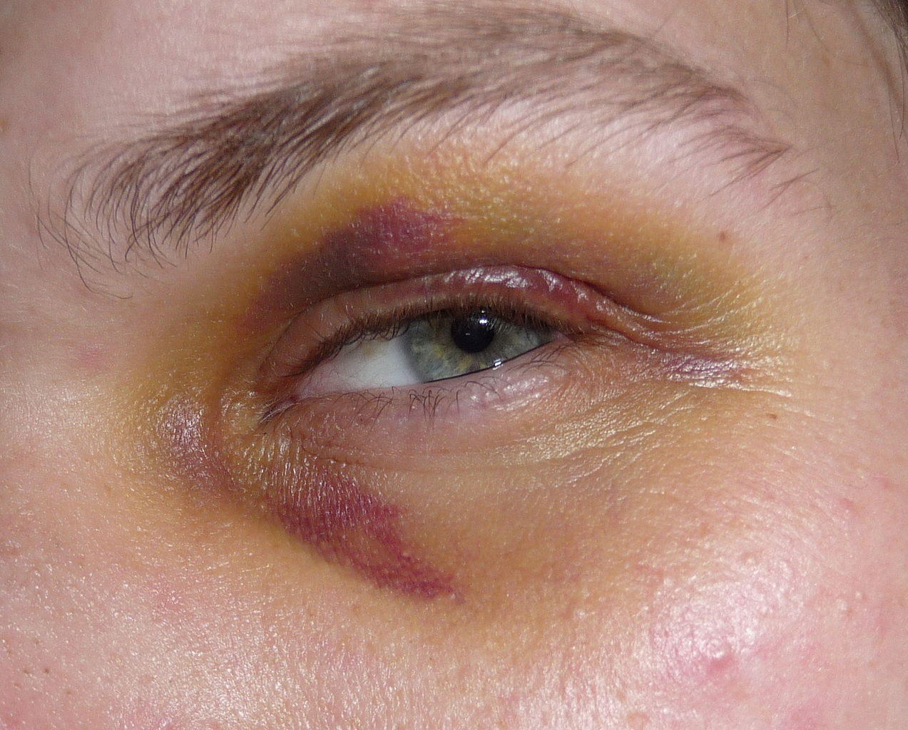 Black Eye – Possible Causes, Signs, Symptoms, and Home Remedies