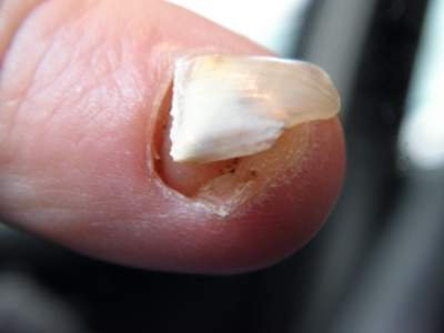 How to Get Rid of Eggshell Nails?