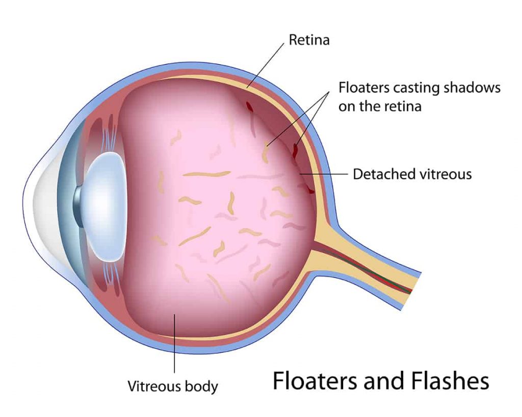 Eye Floaters: Possible Causes, Treatment, and Home Remedies